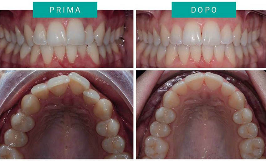 ortodonzia invisibile
