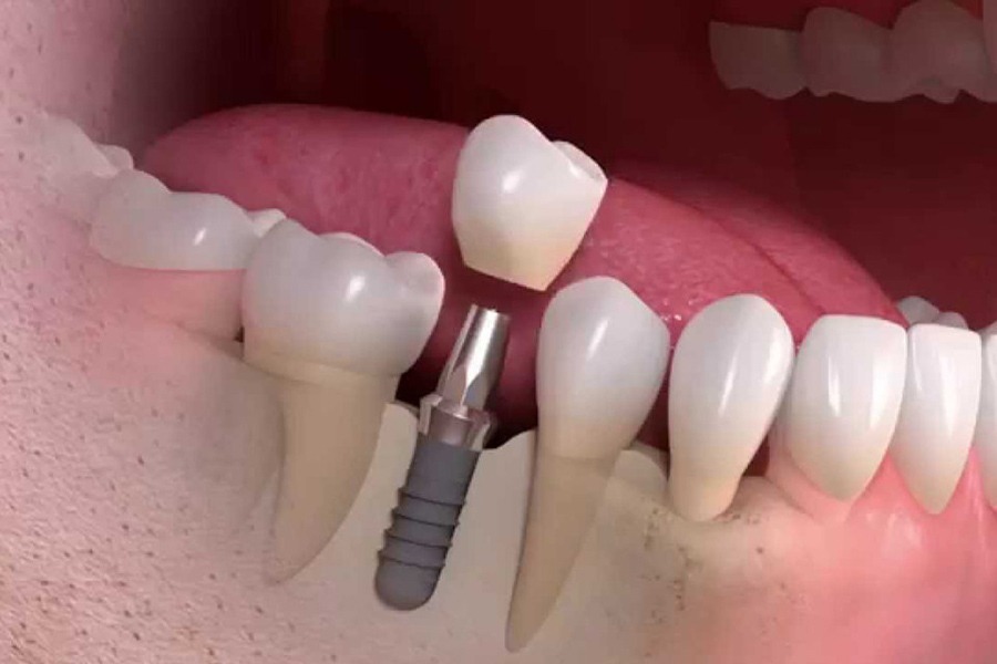 implantologia_studio_dentistico_mazzoni Impianti dentali a Forlì